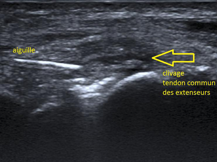 needling